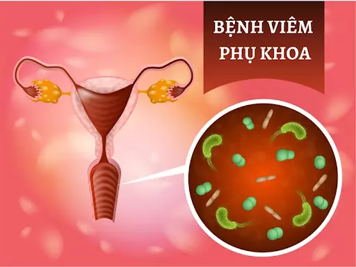 Một số bệnh phụ khoa có thể là nguyên nhân dẫn đến u nang buồng trứng